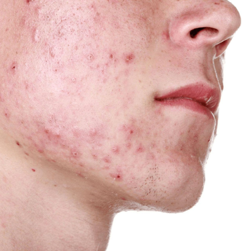 Acne e Imperfecciones